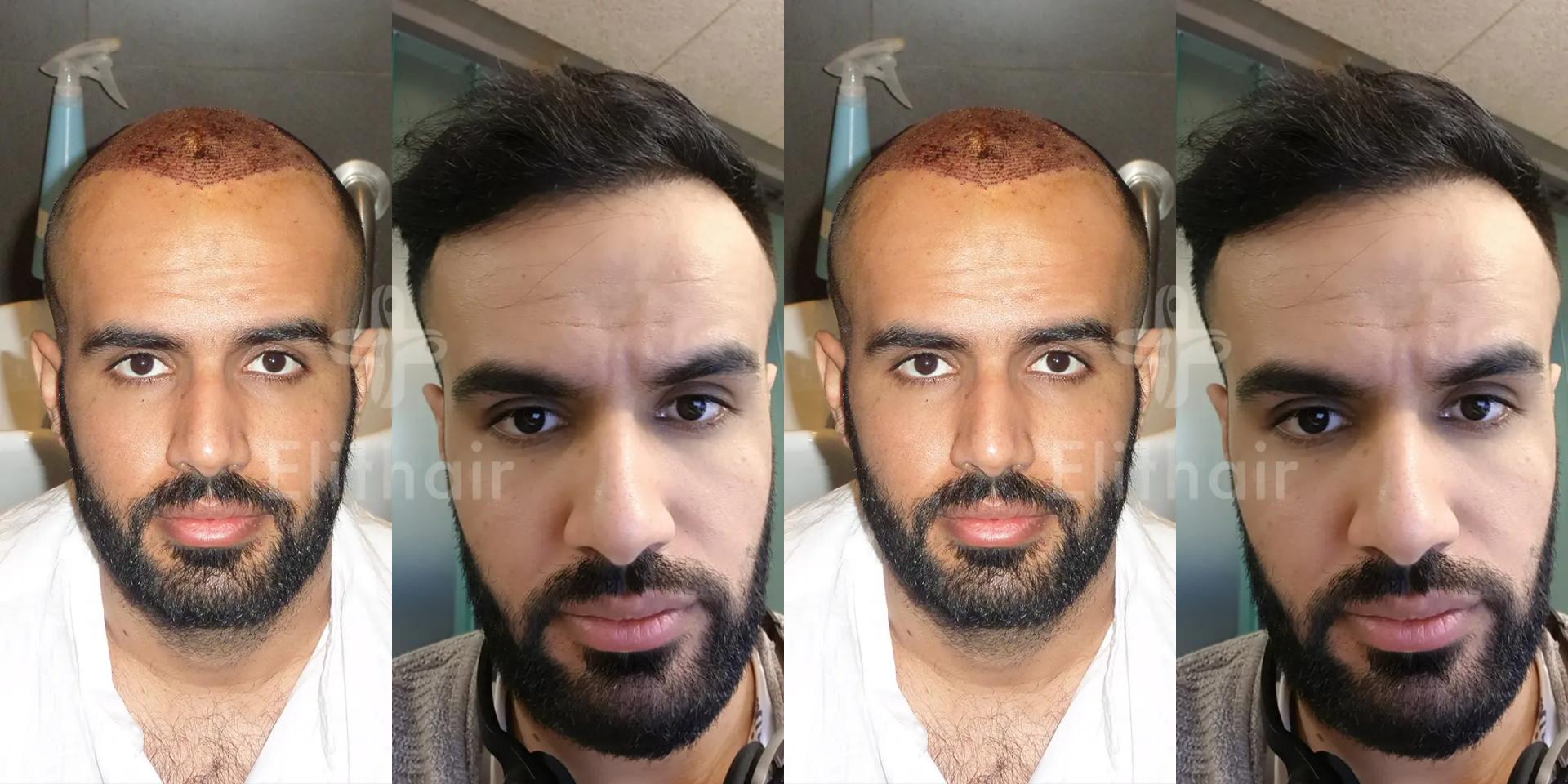 elithairtransplant hair transplant turkey dr balwi estheticon it