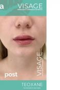 Aumento labbra - Foto del prima - Visage Medicina e Chirurgia Estetica