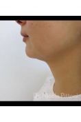 Mesoterapia (rivitalizzazione del viso, collo, decoltè, mani) - Foto del prima - Dott. Nicola Pittoni