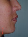 Aumento labbra - Foto del prima - Prof. Franco MIGLIORI
