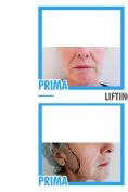 Lifting viso - Foto del prima - Dr. Pietro Loschi