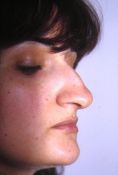Settoplastica (operazione al setto nasale) - Foto del prima - Dott. Dario d