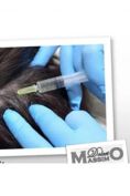 Trapianto capelli - Foto del prima - Dr. Massimo Dolcet
