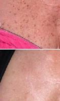 Rimozione tatuaggi - laser - Foto del prima - Dott.ssa Monica De Stefani