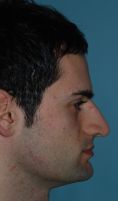 Rinoplastica - Paziente affetto da alterazione di sviluppo del terzo medio ed inferiore del volto. Intervento chirurgico di genioplastica e settorinoplastica funzionale open