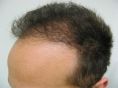 Trapianto capelli - Foto del prima - Dott.ssa Arianna Tinti M.D.