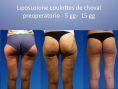 Mastoplastica riduttiva (Riduzione seno) - liposuzione di glutei cosce e culottes de cheval . immagini del postoperatorio a 5 giorni  a  6 mesi.