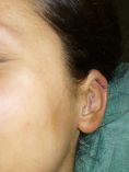 Operazione orecchie (Otoplastica) - Foto del prima - Dott. Alessandro Covacivich