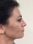Rinoplastica secondaria - Correzione del supratip e dell’angolo naso labiale.