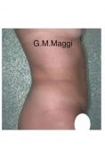 Liposuzione addome - Foto del prima - Dott. Giulio Maria Maggi Chirurgo plastica