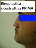 Rinoplastica - Foto del prima - Dott. Enrico Dondè