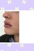 Aumento labbra - Foto del prima - Dott. Massimiliano Giuliano