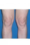 Liposuzione ginocchia - Foto del prima - Dott.ssa Adriana Pozzi