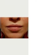 Ingrandimento labbra con grasso (lipofilling) - Foto del prima - LaCLINIQUE of Switzerland®