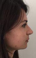Rinoplastica secondaria - Settorinoplasticaterziaria. Riduzione volumetrica di dorso e punta nasale..