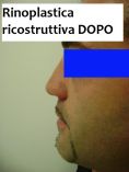 Rinoplastica - Foto del prima - Dott. Enrico Dondè