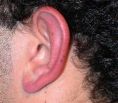 Operazione orecchie (Otoplastica) - Foto del prima - Prof. Vito Contreas