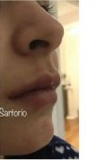 Aumento labbra - Foto del prima - Dott.ssa Cristina Sartorio