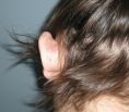 Operazione orecchie (Otoplastica) - Foto del prima - Dott. Ranieri Mazzei