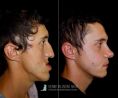 Profiloplastica (Rinoplastica e Mentoplastica) - Approoccio Full Face: Mobilizzazione maxillo-mandibolare-Rinoplastica-Genioplastica-Malaroplastica
Profiloplastica