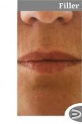 Aumento labbra - Foto del prima - Dott. Edoardo Garassino M.D
