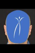 Operazione orecchie (Otoplastica) - Foto del prima - Dott. Leonardo Michele Ioppolo Md
