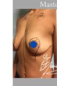 Mastopessi (Lifting del seno) con protesi - Foto del prima - Dott. Edoardo Garassino M.D