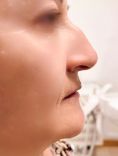 Rinoplastica non chirurgica - Un trattamento breve e non invasivo come il rinofiller consente di correggere piccole imperfezioni del naso e migliorare l’armonia del profilo.