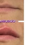 Aumento labbra - Foto del prima - Dott. Antonio  Tambuscio M.D.