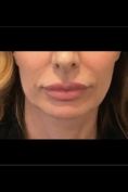 Aumento labbra - Foto del prima - Dott. Massimo Re - Chirurgo plastico ed estetico