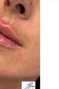 Aumento labbra - Foto del prima - Dott. Marco Galati