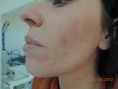 Acne laser, Cicatrici da acne laser - Foto del prima