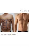Liposuzione addome - Foto del prima - Dott. Francesco Lino