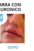 Aumento labbra - Foto del prima - Dott. Alberto Orlandi