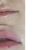 Aumento labbra - Foto del prima - Dott. Giulio Maria Maggi Chirurgo plastica