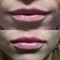 Aumento labbra - Foto del prima - Dott. Luca Zattoni