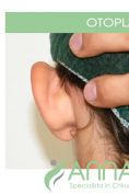 Operazione orecchie (Otoplastica) - Foto del prima - Dott.ssa Anna  Brafa