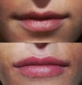 Dott.ssa Liliana De Santo - ____________

Rimodellamento delle labbra con acido ialuronico.