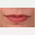 Ingrandimento labbra con grasso (lipofilling) - Foto del prima