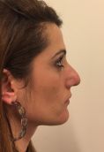 Rinoplastica - Settorinoplastica primaria. Regolarizzazione del dorso nasale in tecnica open. Rotazione e definizione della punta nasale con resezione cefalica alari, suture trans ed interdomali.