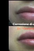 Aumento labbra - Foto del prima - Dott. Vincenzo Nunziata