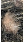 Trapianto capelli - Foto del prima - Dott.ssa Giulia Bianchi