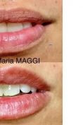 Aumento labbra - Foto del prima - Dott. Giulio Maria Maggi Chirurgo plastica