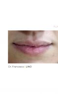 Aumento labbra - Foto del prima - Dott. Francesco Lino