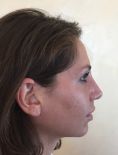 Dott. Tito Marianetti - Settorinoplasticaprimaria. Importante riduzione del volume della piramide nasale intervenendo su ossa nasali, cartilagini triangolari, alari, setto e spina nasale anteriore. Deproiezione e rotazione della punta. Armonizzazione del profilo.