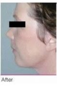 Mesoterapia (rivitalizzazione del viso, collo, decoltè, mani) - Foto del prima - Dott. NICOLA CATANIA