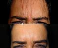 Clinica Estetica Europa - Botox frontale eseguito dal Dott. Ikenna Valentine Aboh