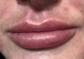 Aumento labbra - Foto del prima - Centro Clinico Agorà