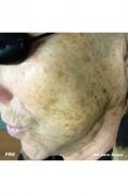 Procedure laser in dermatologia estetica  - Foto del prima - Dott.ssa Sara Russo