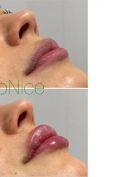 Aumento labbra - Foto del prima - Dr. Mario Gioia